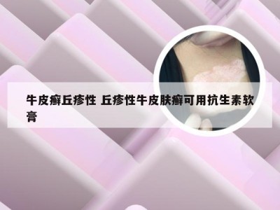 牛皮癣丘疹性 丘疹性牛皮肤癣可用抗生素软膏