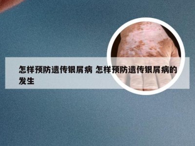 怎样预防遗传银屑病 怎样预防遗传银屑病的发生