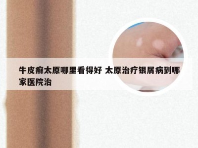 牛皮癣太原哪里看得好 太原治疗银屑病到哪家医院治