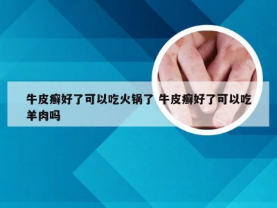 牛皮癣好了可以吃火锅了 牛皮癣好了可以吃羊肉吗