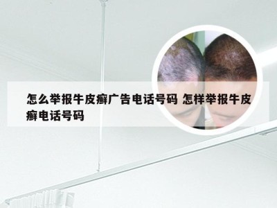 怎么举报牛皮癣广告电话号码 怎样举报牛皮癣电话号码
