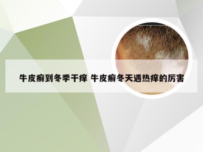 牛皮癣到冬季干痒 牛皮癣冬天遇热痒的厉害