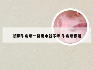 初期牛皮癣一挤出水就不痒 牛皮癣摸着