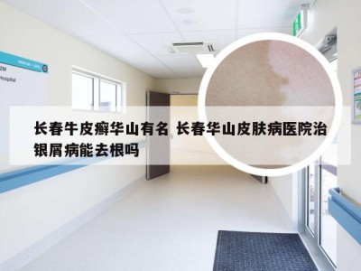 长春牛皮癣华山有名 长春华山皮肤病医院治银屑病能去根吗