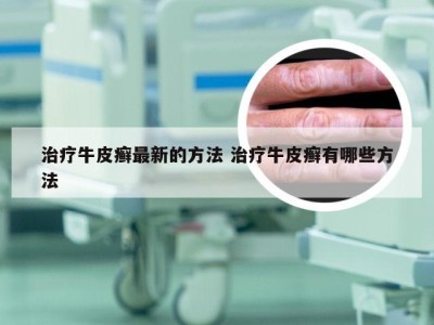 治疗牛皮癣最新的方法 治疗牛皮癣有哪些方法