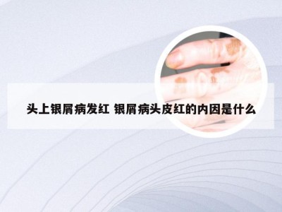 头上银屑病发红 银屑病头皮红的内因是什么