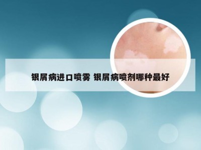 银屑病进口喷雾 银屑病喷剂哪种最好