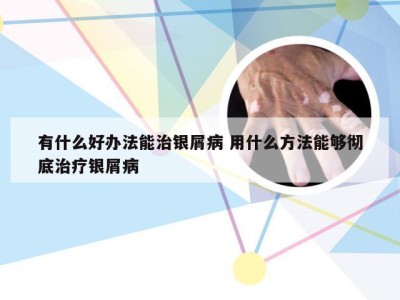 有什么好办法能治银屑病 用什么方法能够彻底治疗银屑病