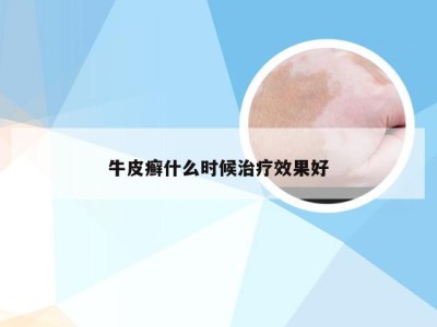 牛皮癣什么时候治疗效果好