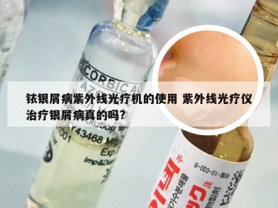 铱银屑病紫外线光疗机的使用 紫外线光疗仪治疗银屑病真的吗?