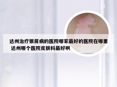 达州治疗银屑病的医院哪家最好的医院在哪里 达州哪个医院皮肤科最好啊