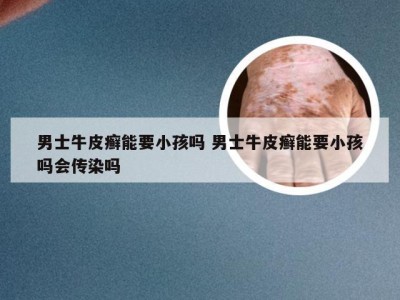 男士牛皮癣能要小孩吗 男士牛皮癣能要小孩吗会传染吗