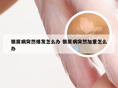 银屑病突然爆发怎么办 银屑病突然加重怎么办