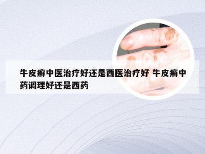 牛皮癣中医治疗好还是西医治疗好 牛皮癣中药调理好还是西药