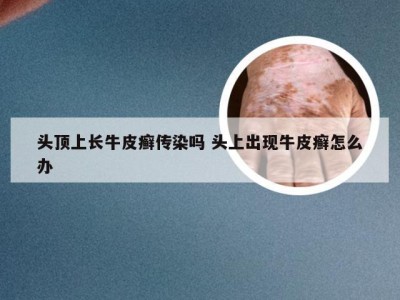 头顶上长牛皮癣传染吗 头上出现牛皮癣怎么办