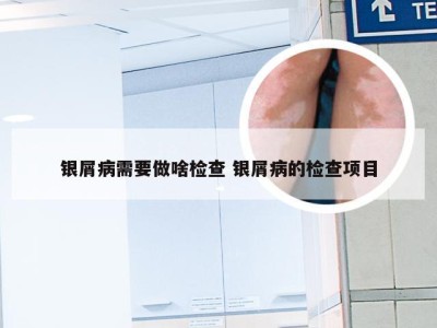 银屑病需要做啥检查 银屑病的检查项目