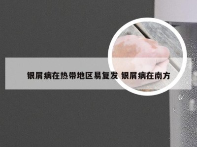 银屑病在热带地区易复发 银屑病在南方
