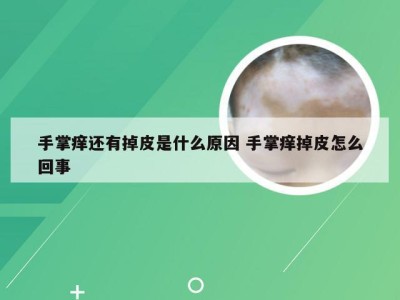 手掌痒还有掉皮是什么原因 手掌痒掉皮怎么回事