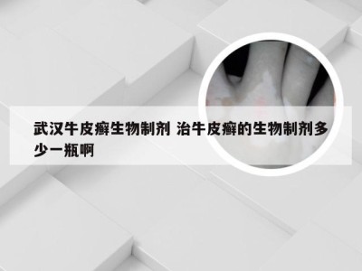 武汉牛皮癣生物制剂 治牛皮癣的生物制剂多少一瓶啊