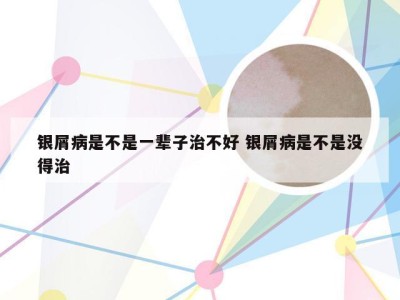 银屑病是不是一辈子治不好 银屑病是不是没得治