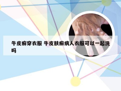 牛皮癣穿衣服 牛皮肤癣病人衣服可以一起洗吗