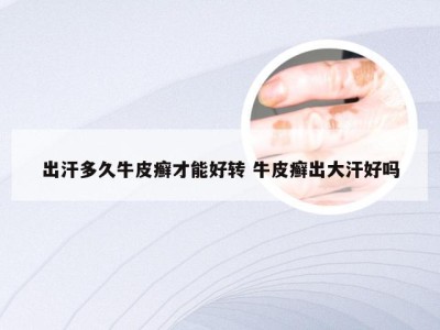 出汗多久牛皮癣才能好转 牛皮癣出大汗好吗