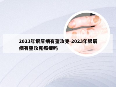 2023年银屑病有望攻克 2023年银屑病有望攻克癌症吗