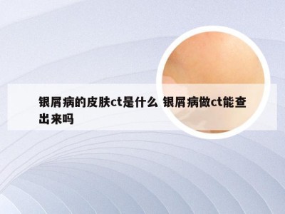 银屑病的皮肤ct是什么 银屑病做ct能查出来吗