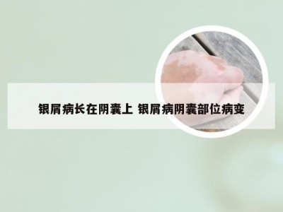 银屑病长在阴囊上 银屑病阴囊部位病变