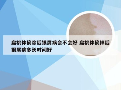 扁桃体摘除后银屑病会不会好 扁桃体摘掉后银屑病多长时间好