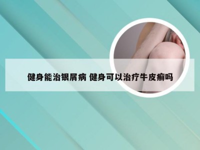 健身能治银屑病 健身可以治疗牛皮癣吗