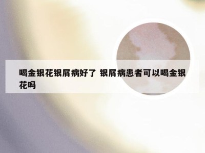 喝金银花银屑病好了 银屑病患者可以喝金银花吗