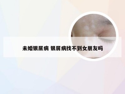 未婚银屑病 银屑病找不到女朋友吗