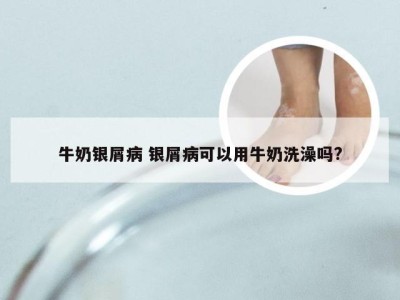 牛奶银屑病 银屑病可以用牛奶洗澡吗?