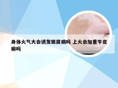身体火气大会诱发银屑病吗 上火会加重牛皮癣吗