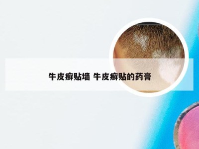 牛皮癣贴墙 牛皮癣贴的药膏