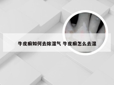 牛皮癣如何去除湿气 牛皮癣怎么去湿
