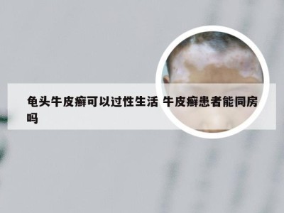 龟头牛皮癣可以过性生活 牛皮癣患者能同房吗