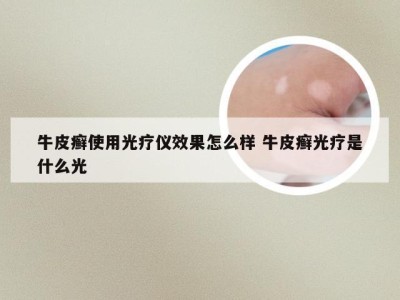牛皮癣使用光疗仪效果怎么样 牛皮癣光疗是什么光