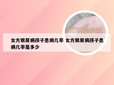 女方银屑病孩子患病几率 女方银屑病孩子患病几率是多少