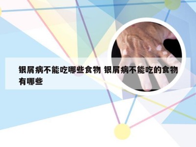 银屑病不能吃哪些食物 银屑病不能吃的食物有哪些