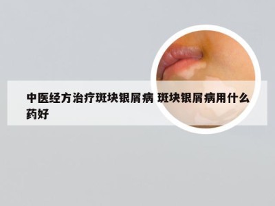 中医经方治疗斑块银屑病 斑块银屑病用什么药好