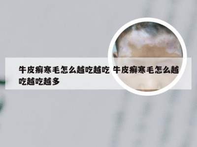 牛皮癣寒毛怎么越吃越吃 牛皮癣寒毛怎么越吃越吃越多