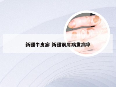 新疆牛皮癣 新疆银屑病发病率