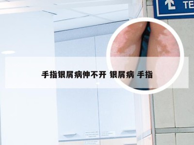 手指银屑病伸不开 银屑病 手指