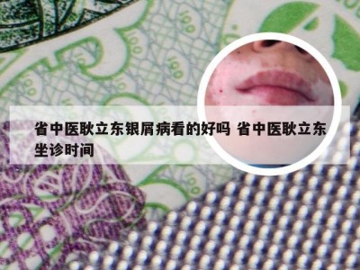 省中医耿立东银屑病看的好吗 省中医耿立东坐诊时间