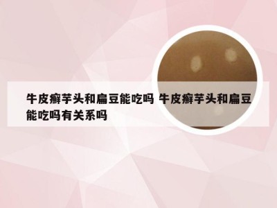 牛皮癣芋头和扁豆能吃吗 牛皮癣芋头和扁豆能吃吗有关系吗
