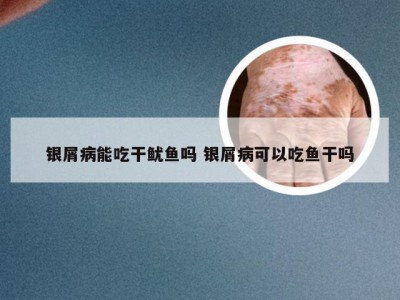 银屑病能吃干鱿鱼吗 银屑病可以吃鱼干吗