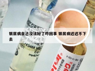 银屑病自己没法好了咋回事 银屑病迟迟不下去