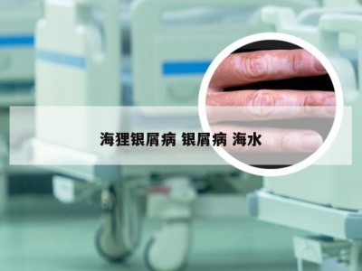 海狸银屑病 银屑病 海水
